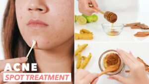 Ayurvedic Acne Cream Manufacturers in India