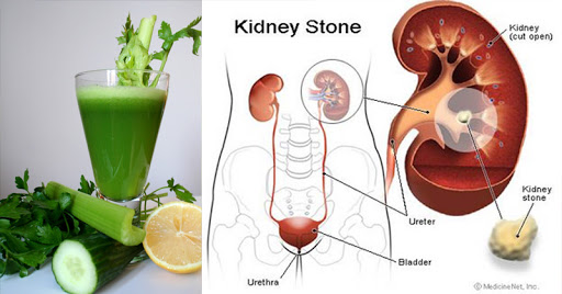 Kidney Stone Syrup Manufacturers in India